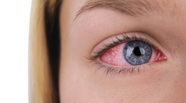 Allergy Season – and how it affects your eyes
