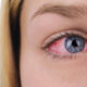 Allergy Season – and how it affects your eyes