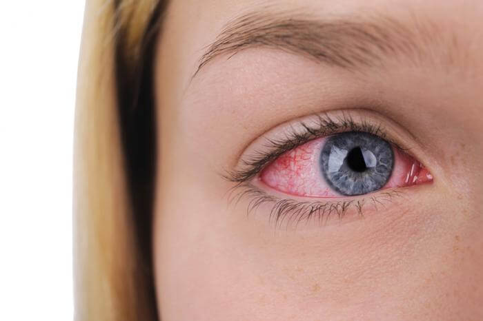 Allergy Season – and how it affects your eyes