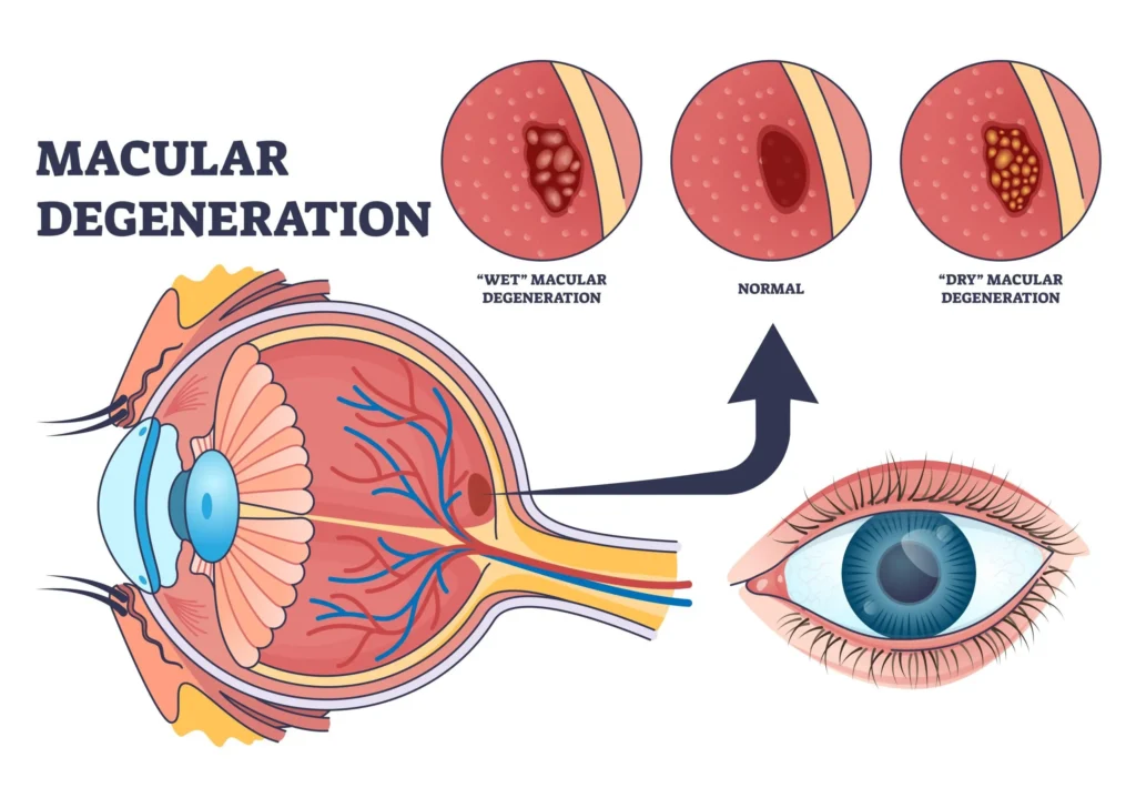 macular degeneration