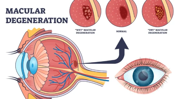 macular degeneration