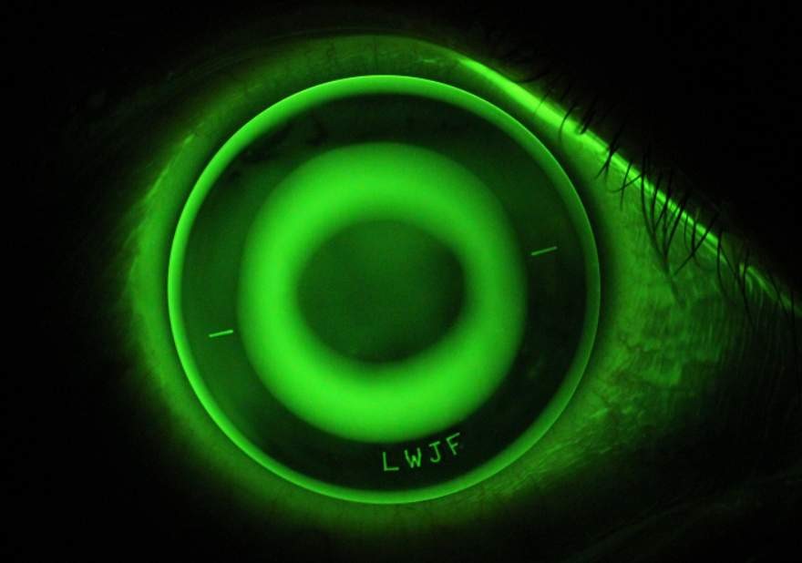 Orthokeratology (Ortho-K)