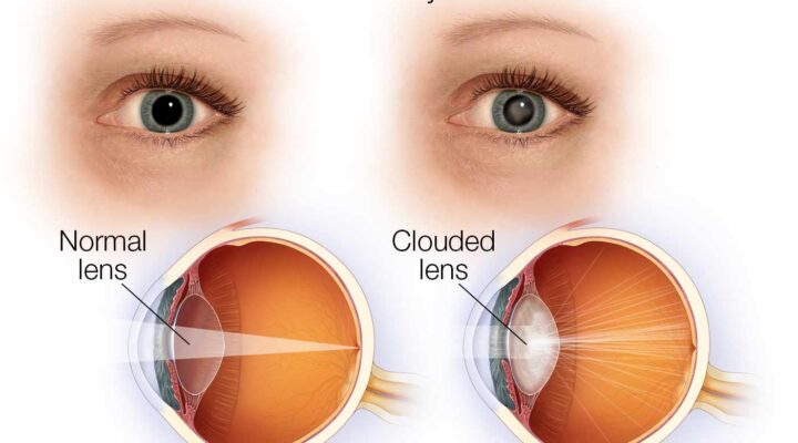 Grant and Douglas cataract