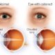 cataract Grant and Douglas cataract
