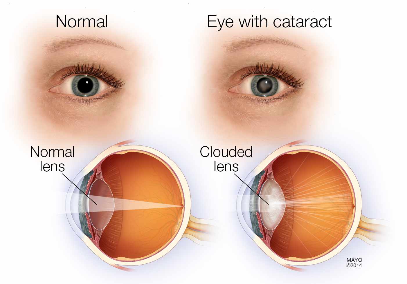 Grant and Douglas cataract