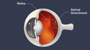 Flashes, Floaters and Shadows – Spotting the Signs of Retinal Detachment