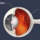 retinal detachment retinal detachment