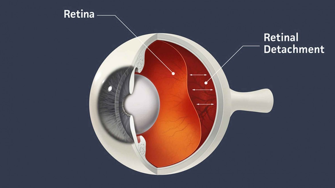 retinal detachment